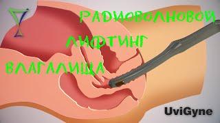 Радиоволновой RF лифтинг влагалища: эффективная процедура омоложения в гинекологии
