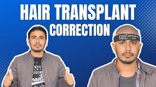 Hair Transplant in Indore | Best Results & Cost of Hair Transplant in Indore