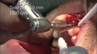 Astra Tech Implant System - Drilling