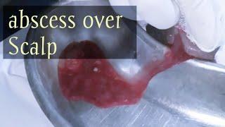 Pus Scalp abscess ‼️ || #whatilearntoday || abscess || pus || Eiter