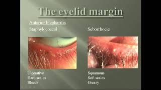 A Class On The Eyelid Margin By Dr U Viveka Nandu Dept Of Ophthalmology