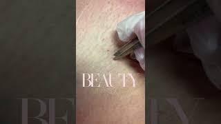 Ingrown Hair Removal