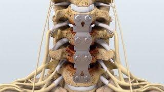 $650K Result: Animated C4-7 Anterior Cervical Discectomy with Fusion