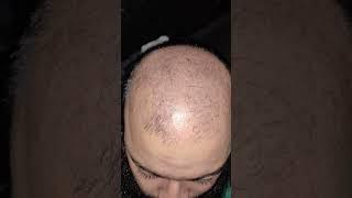 Traya Review After 10 Days !! Shocking Results #traya #hairloss #hairlosstreatment