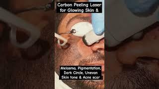 Carbon Peeling Laser Treatment #Beautytips #lasertreatment #skincare