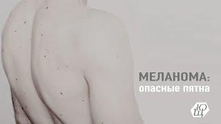 Меланома: опасные родинки