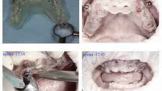 Имплантация зубов "Всё на 4-х имплантатах" и "Всё на 6-ти имплантатах" при полном отсутствии зубов