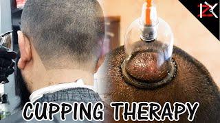 How To Cure Headaches | Wet Cupping Therapy Performed | Migraine Treatment | Hijama | THIS WORKED!