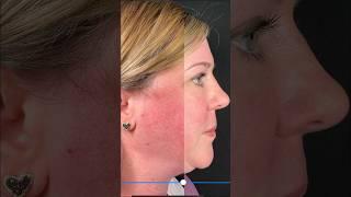 Treatment for Redness & Rosacea