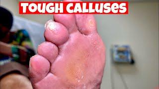 Plantar Callus Shaving