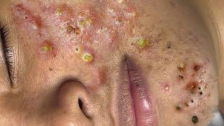 Big Cystic Acne Blackheads Extraction Blackheads & Milia, Whiteheads Removal Pimple Popping # 1558