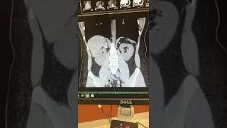 Adrenal Adenoma #cushingssyndrome #cushings #cushingsdisease #adrenaladenoma #adrenalectomy