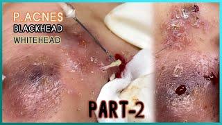 Big Cystic Acne Blackheads Extraction Blackheads & Milia, Whiteheads Removal Pimple Popping