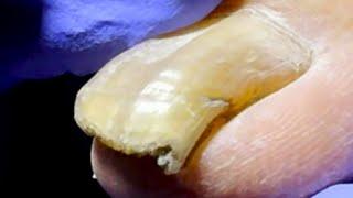 Toenails Are A Weird Shape, Trimmed Successfully【Dr. Liu's Pedicur】
