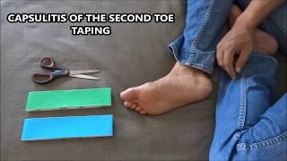 Capsulitis of the second toe taping