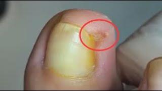 How to take care of sensitive nail by Mr toenail