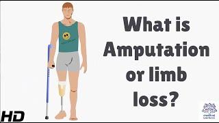 What is Amputation or Limb Loss?