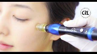 Microneedling with InnoPen - via GLO Anti-Aging Treatment Bar