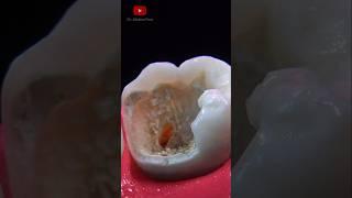 Dental Restoration #asmr #dentist