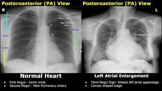 Chest X-Ray Heart Normal Vs Abnormal Image Appearances | Cardiac Diseases On Radiography (CXR)