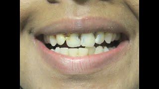 Front teeth cavities ?Smile makeover/ Cosmetic dentistry by Dr Trivikram Bangalore.