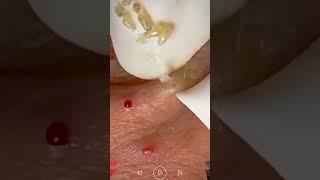Skincare | Blackheads Removal #493 #tweezers skincare #blackheads blackheads