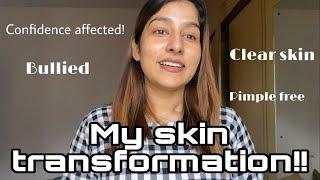 How I cleared my pimples | skin transformation|Sajna Shamsudheen#skincare #skintreatment #pimplefree