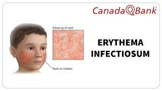 Erythema Infectiosum