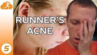 Dealing with Runner's Acne