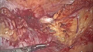 POST HYSTERECTOMY OVARIAN CYST