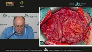 Identification of the peritoneal carcinomatosis index in patients with advanced ovarian cancer