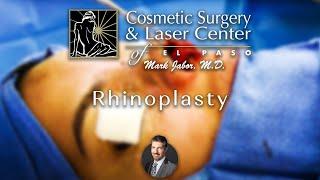 Rhinoplasty - Cosmetic Surgery and Laser Center of El Paso | Dr. Mark Jabor
