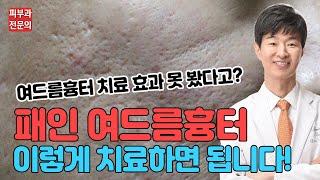 여드름흉터 없애는법, 여드름 흉터치료 이렇게 하세요! 피부과 전문의가 알려드림~