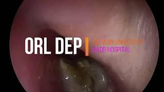 Endoscopic FB Removal from the nose