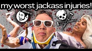 My Most Serious Jackass Injuries | Steve-O