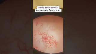 Inside a uterus with Asherman's! #infertility #uterus #scar #infection #miscarriage #ashermans