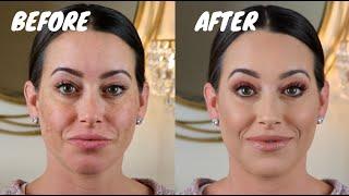 FULL COVERAGE MAKEUP FOR MELASMA & HYPERPIGMENTATION (pregnant foundation routine)