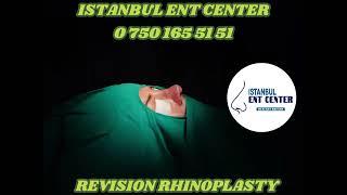 Revision Rhinoplasty - Istanbul ENT Center - #septorhinoplasty #ultrasonicrhinoplasty #nosejob