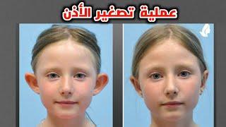 شاهد عملية تصغير الأذن_Ear reduction surgery