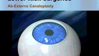 Ab Externo Canaloplasty for Glaucoma