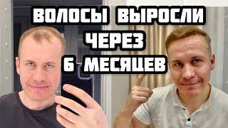 ПЕРЕСАДКА ВОЛОС 6 месяцев. Результаты моей пересадки волос