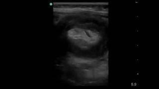 Perforation from Air Enema for Intussusception