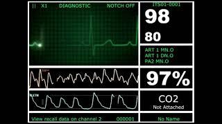 Кардиомонитор | Пульс | Ритма сердечного слежение