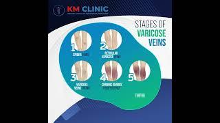 STAGES OF VARICOSE VEINS #shorts #shortsvideo #shortsyoutube