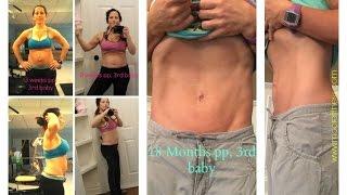 Your Guide to Treating Diastasis Recti (Part 2)