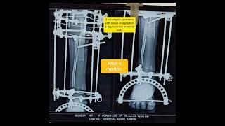 ilizarov surgery bone transport radiological progress