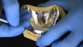 CUSTOM-MADE TRAY FOR COMPLETE DENTURE IMPRESSIONS