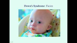 Downs Syndrome - CRASH! Medical Review Series