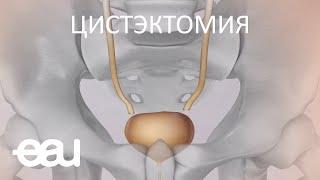 ЦИСТЭКТОМИЯ  (EAU - cystectomy RU)