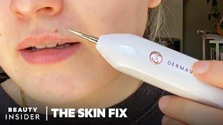 Heated Needle Tool Claims To Remove Skin Tags And Moles At Home | The Skin Fix | Beauty Insider